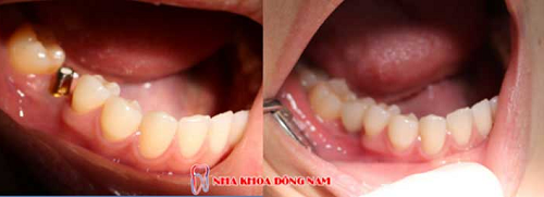 Trồng răng cấm giá bao nhiêu là chuẩn nhất? - ảnh 1