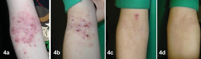 Trị hiệu quả viêm da cơ địa trẻ em bằng thảo dược - ảnh 1