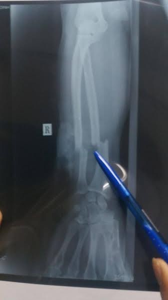 Nối thành công cánh tay người đàn ông bị chém đứt lìa - ảnh 1