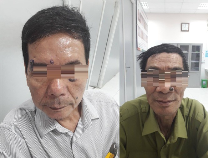 Phát hiện bị ung thư khi đi tẩy nốt ruồi - ảnh 1