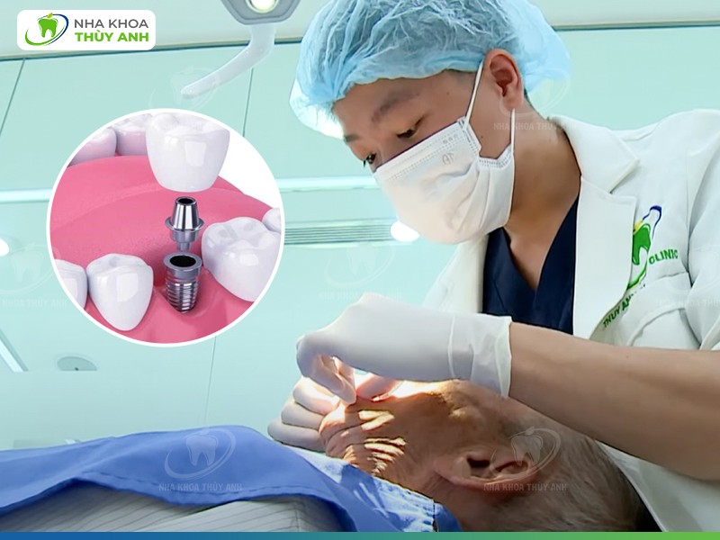 Kỹ thuật trồng răng Implant flapless tại nha khoa Thùy Anh ảnh 1