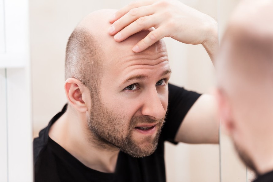 Rụng tóc, hói đầu: để lâu khó chữa
