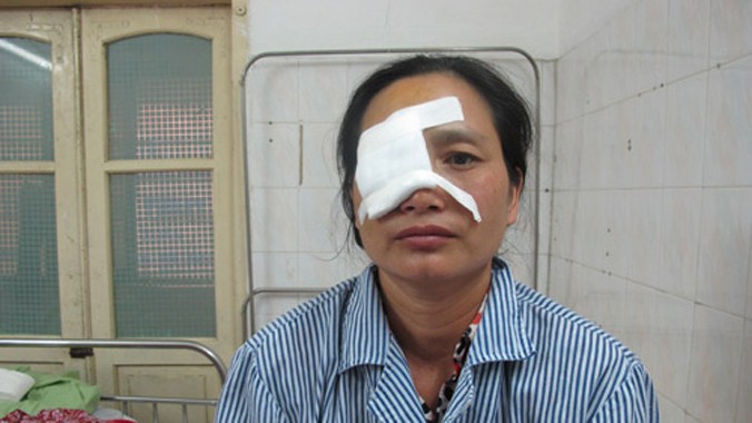 Bệnh nhân bị mất thị lực vĩnh viễn mắt bên phải.
