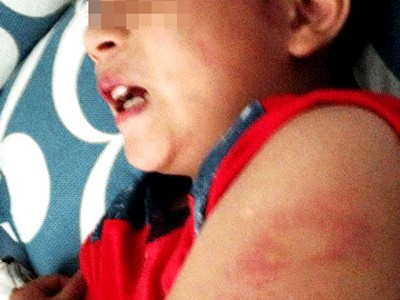 Vết bầm trên mặt, tay bé trai 9 tuổi vì bị cha đánh