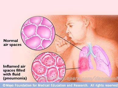 Xuất hiện chứng viêm phổi lạ