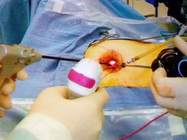 Sử dụng nội soi một lỗ cắt u tuyến thượng thận