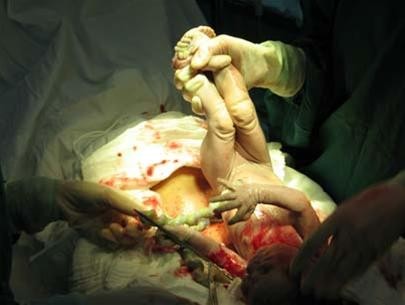 Vì sao bé sơ sinh gãy 2 chân, 1 tay ở bệnh viện?