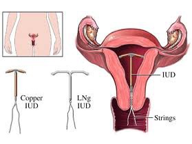 Dụng cụ tránh thai trong tử cung làm giảm nguy cơ ung thư