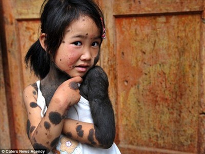 Bệnh ‘lông lá’ tấn công bé gái 6 tuổi