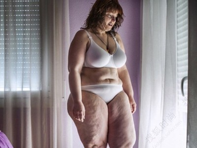 Hành trình phẫu thuật giảm béo của cô gái 124 kg