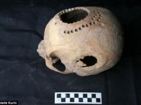1.000 năm trước, người Peru đã biết phẫu thuật não