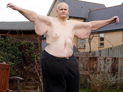 Người đàn ông béo nhất thế giới giảm hơn 290 kg
