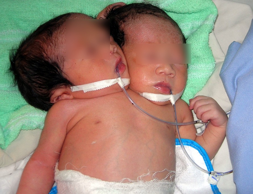 Một bé gái sơ sinh có hai đầu, ba tay