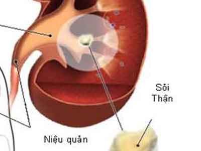 Sỏi thận dễ dẫn đến suy thận