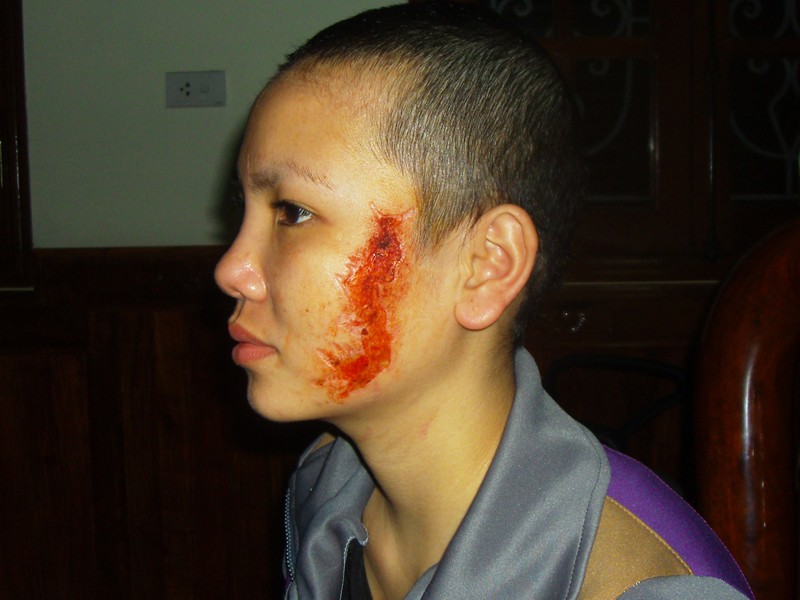 Sau khi bị cạo trọc tóc, xăm hình lên mặt, thể chất và tinh thần của Giang bị tổn thương nghiêm trọng. Ảnh: Quang Long