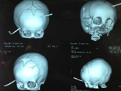 Điều kỳ diệu với bé bị thanh sắt đâm xuyên đầu