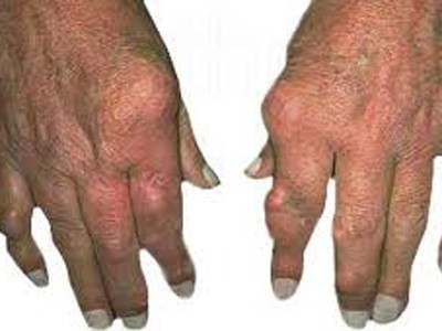 90% bệnh nhân viêm khớp dạng thấp biểu hiện ở bàn ngón tay