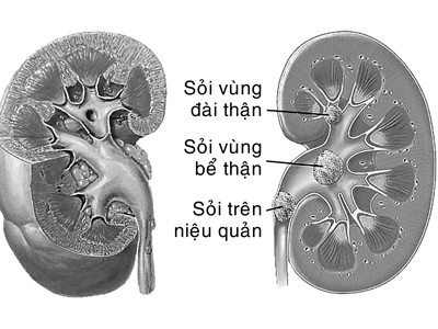 Sỏi thận - Ngăn ngừa tái phát trong điều trị