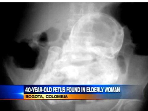 Bào thai vôi hóa 40 năm được tìm thấy trong bụng cụ bà