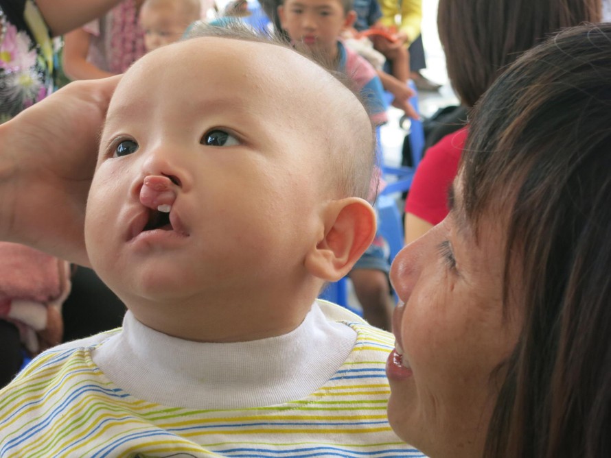 Chương trình phẫu thuật nhân đạo cho trẻ bị dị tật khe hở môi và vòm miệng tại Vinmec