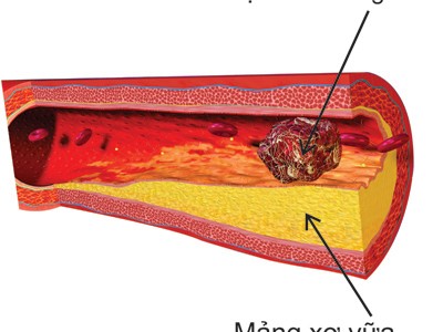 Cứu tinh cho bệnh nhân đau tim (Đau thắt ngực)