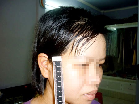 Chị Loan với mái tóc lởm chởm do bị chồng cắt