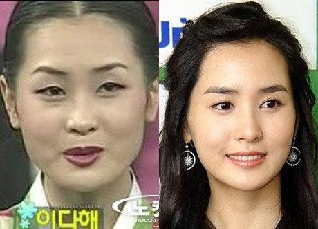 Sốc với gương mặt thay đổi sau thẩm mỹ của Lee Da Hae