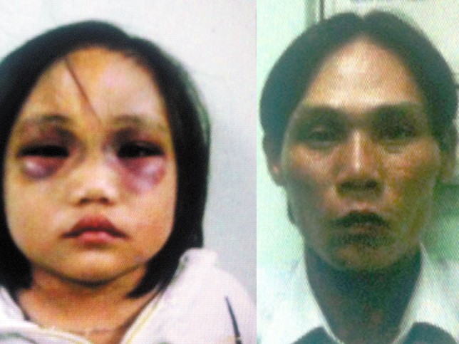 Bé gái 5 tuổi bị cha hành hạ tàn nhẫn