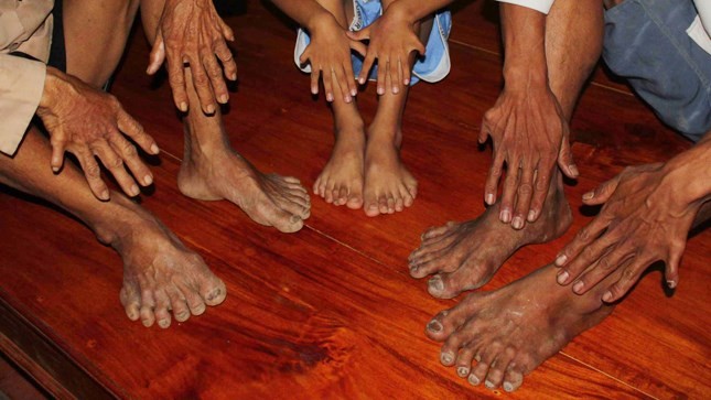 “Giải mã” gia tộc 6 đời thừa ngón chân tay