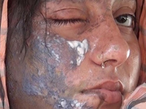 Từ chối cầu hôn, nữ diễn viên bị ném acid vào mặt