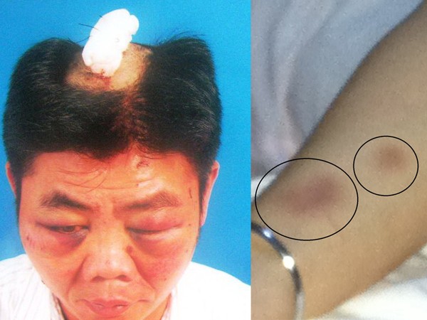 Một Việt kiều bị bắt cóc, đánh đập dã man