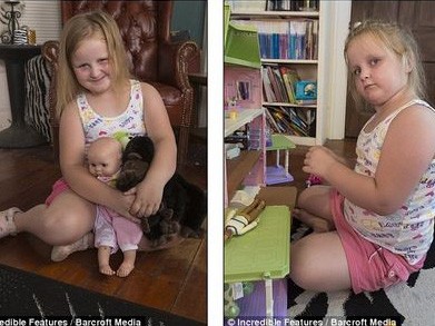Bé gái 6 tuổi đối mặt chứng bệnh “người hóa đá”