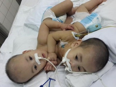 Hai em bé dính liền tim, gan ở Sài Gòn được tách rời