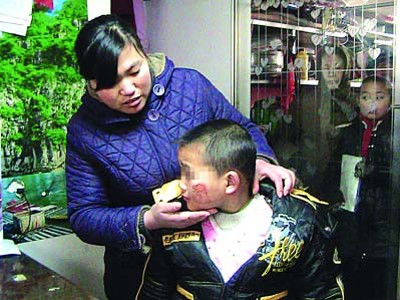 Chị Cheng Sixia chỉ vết bỏng trên mặt con trai