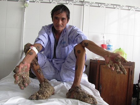 Người đàn ông mọc 'san hô' ở chân tay, dùng kéo tự cắt