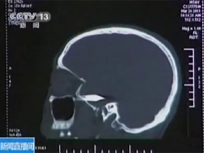 Nhờ chụp não, các bác sĩ đã phát hiện ra viên đạn găm trong đầu nạn nhân