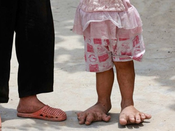 Cô bé ba tuổi có bàn chân khổng lồ