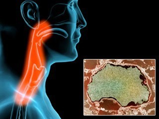 Quan hệ bằng miệng dẫn tới ung thư họng