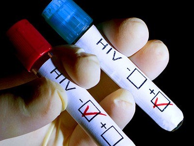 Nhiễm hai chủng vi-rút HIV làm chậm tiến triển bệnh