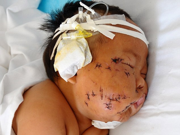 Em bé bị mẹ dùng kéo đâm nát mặt