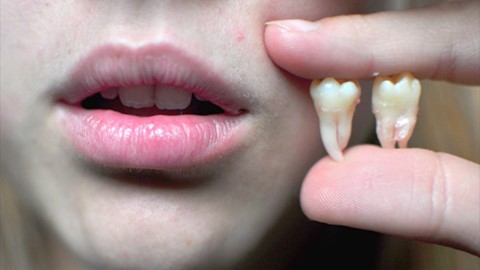 Vì sao răng khôn lại đau và chúng ta có nên nhổ hay không?
