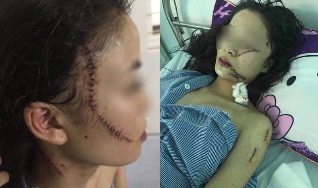 Toàn cảnh thiếu nữ 18 tuổi bị 3 cô gái đánh đập, rạch mặt giữa đêm
