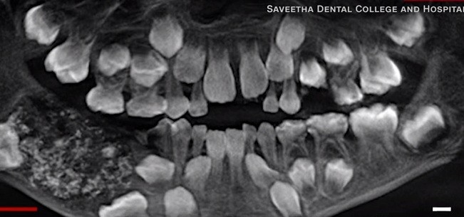 Ảnh chụp X-quang những chiếc răng trong miệng cậu bé