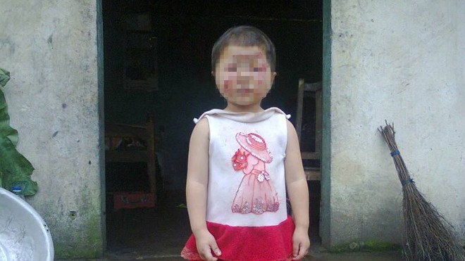 Cháu bé bị bỏng hết mặt vẫn được gia đình đưa đến trường.