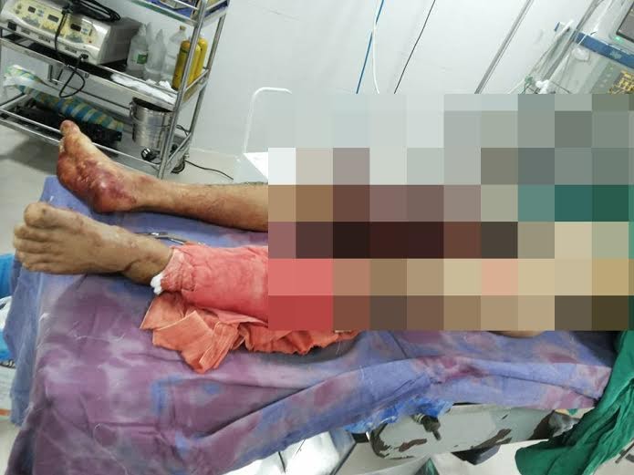 Một nạn nhân vụ lật xe công nông đang được điều trị tại bệnh viện 115 Nghệ An.