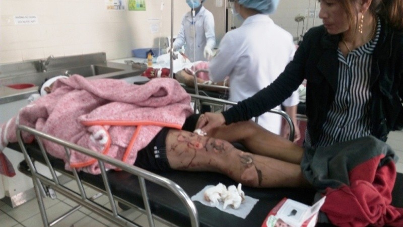 Nạn nhân vụ nổ tàu cá được điều trị chống bỏng tại Bệnh viện T.Ư Huế. 