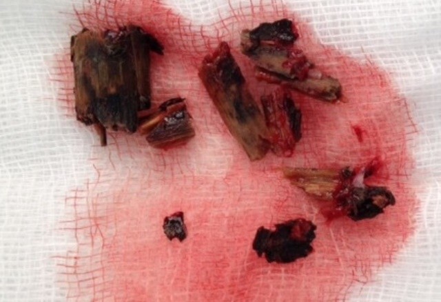 Các mảnh gỗ còn sót lại trong hốc mắt bệnh nhân đã được gắp ra qua kỹ thuật nội soi. Ảnh do bệnh viện cung cấp.