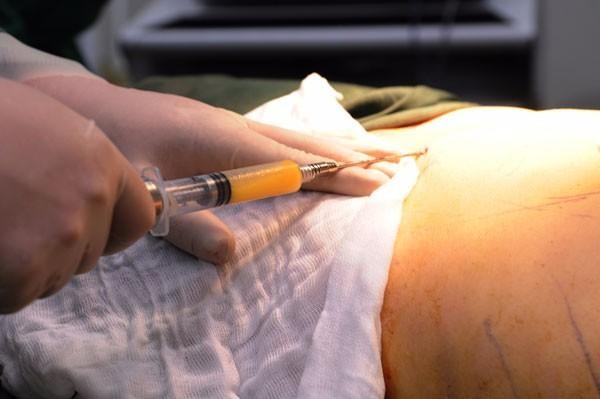 Nữ bệnh nhân ở TPHCM tử vong sau khi hút mỡ bụng làm đẹp