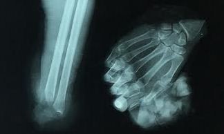 Phim X-quang bàn tay trái bị đứt lìa trước khi được nối của ông T. Ảnh do bệnh viện cung cấp.
