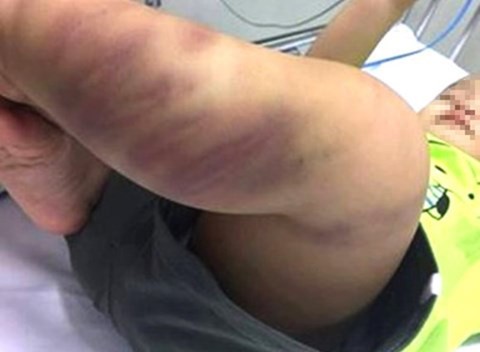 Bé trai bị bạo hành hiện đang được chăm sóc và điều trị đặc biệt tại BV Nhi TƯ. Ảnh: Internet